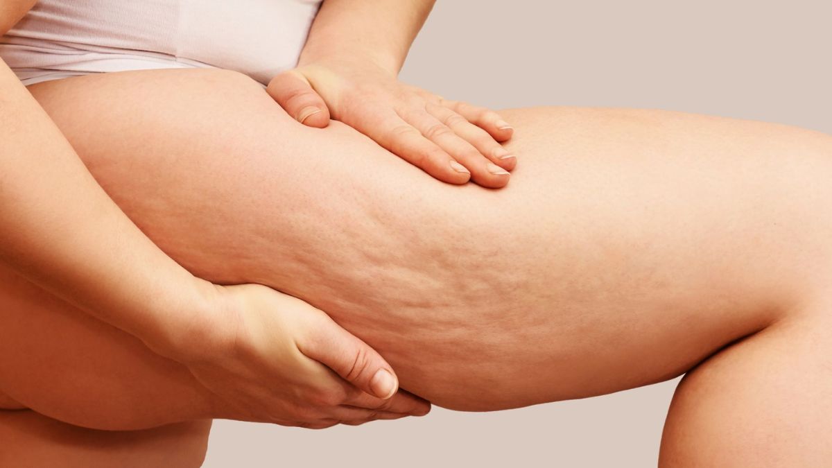 Cellulite Remedies