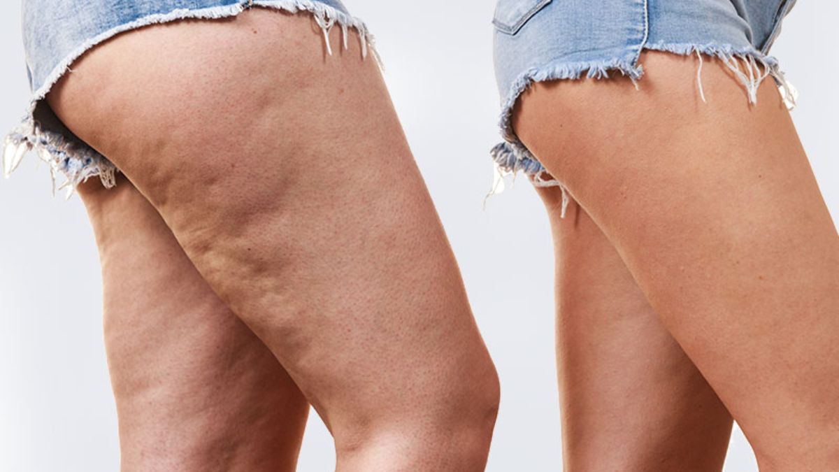 How To Get Rid Of Cellulite Naturally?