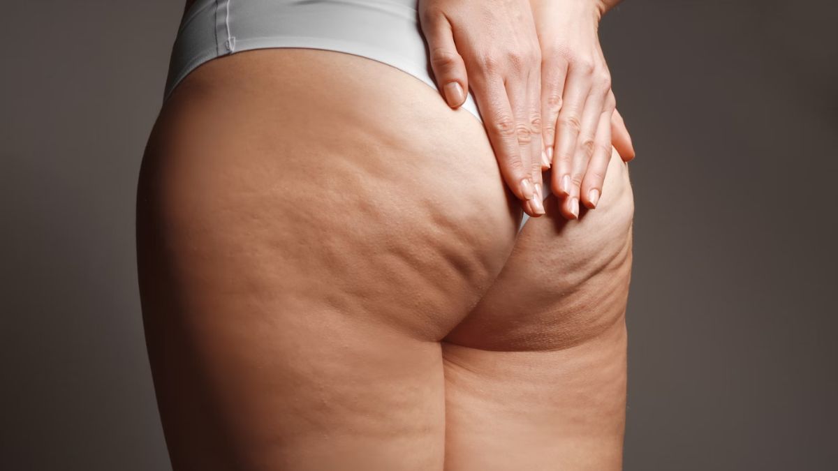 What is the primary cause of cellulite?